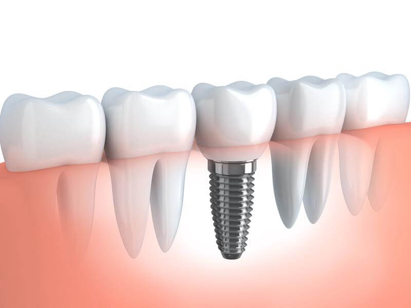 Dental Implants  Mt Kisco, NY 